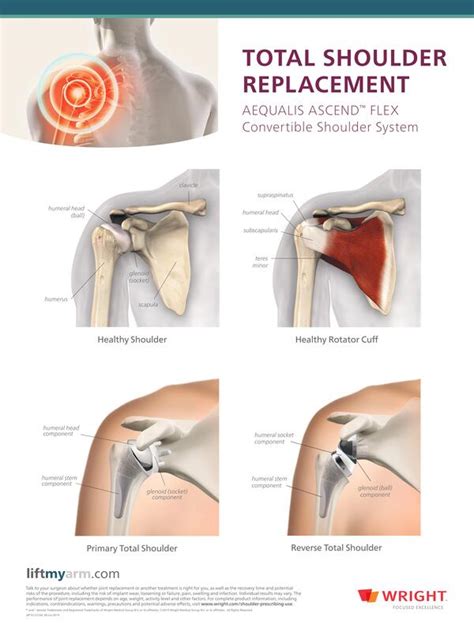 Your Guide To Reverse Shoulder Replacement And Recovery 52 Off