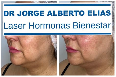 Exilis Ultra Dr Jorge Alberto El As