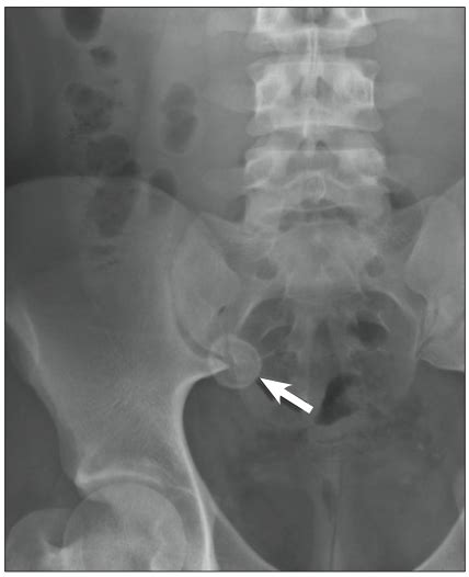 Appendicolith With Acute Appendicitis Consultant360