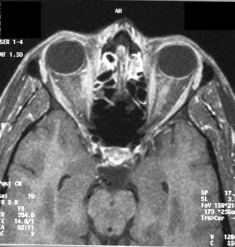 Gadolinium-enhanced MRI scan showing enlarged left optic nerve ...