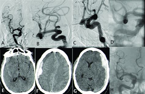 Case 4 A C Right Middle Cerebral Artery MCA Bifurcation Aneurysm