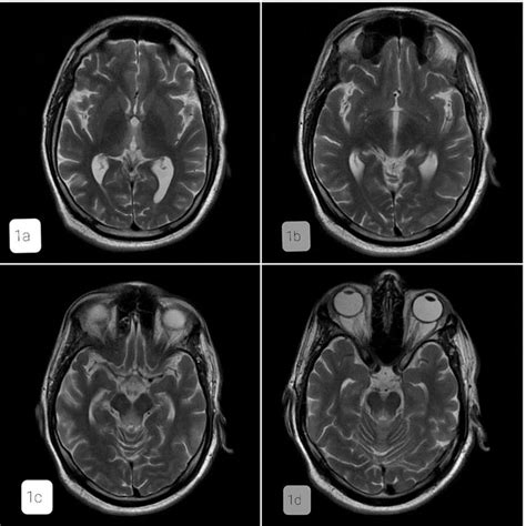 Axial T2W MRI images show symmetrical areas of high signal intensity in ...