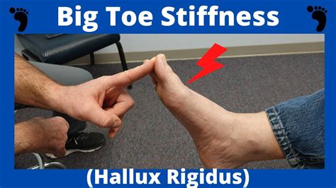 Stiff Big Toe Joint Hallux Rigidus Treatment Youtube