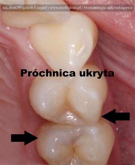 Co to jest próchnica ukryta NZOS MEDI DENT