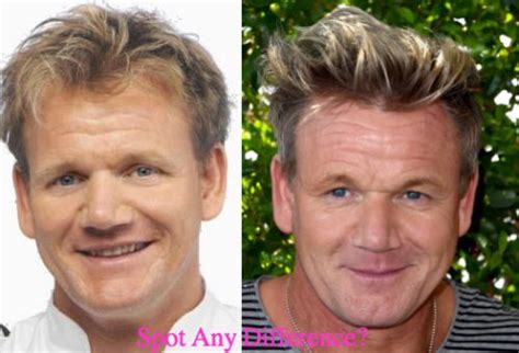 Gordon Ramsay Plastic Surgery Before and After Photos - Latest Plastic Surgery Gossip And News ...