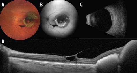 Hemorrhage Over A Choroidal Nevusharmless Or Hazardous Retina Today