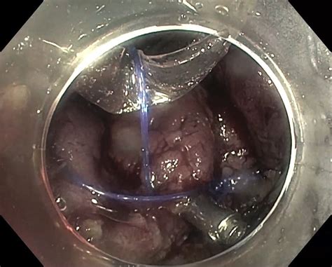 Dissected Anal Margin Of The Polyp Is Connected To The Foreballoon Of