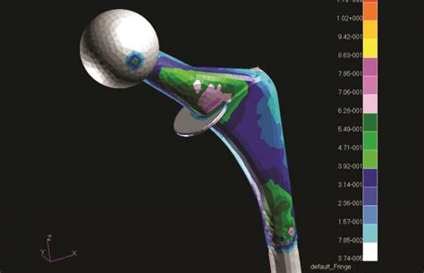 Orthopedic Implants Finite Element And Cfd Simulation And Design Enteknograte