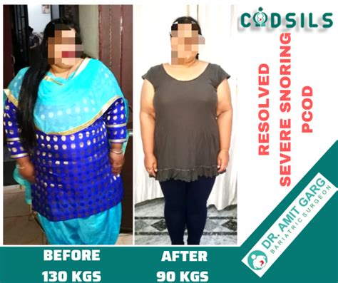 Bariatric Surgery Results Success Stories Dr Amit Garg