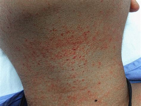 Idiopathic Thrombocytopenic Purpura Rash