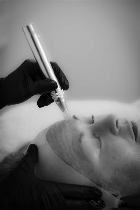 Skin Needling — Melissa Jean Skin Therapy