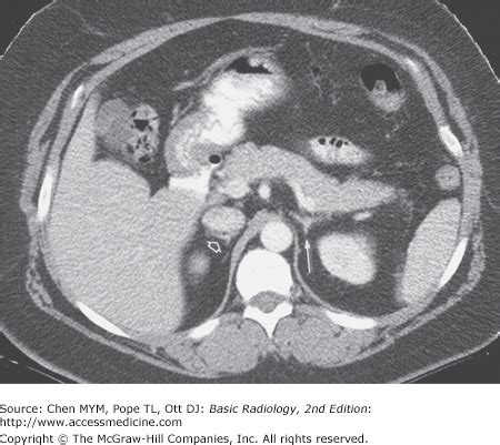 Chapter 9 Radiology Of The Urinary Tract Radiology Key