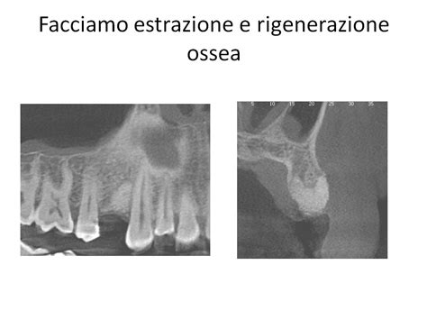 Frattura Di Premolare Dentista Roma