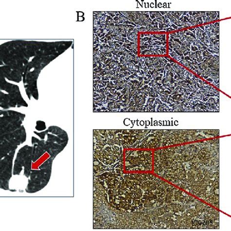 Higher Rate Of Mdig Expression In Human Synchronous Multiple Primary