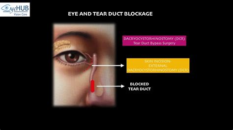 Block Tear Duct Part 1 Watering In Eyes Endoscopic Dacryocystorhinostomy Tear Duct Surgery