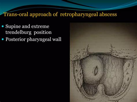 Surgical Treatment Of Paraphyrngeal And Retropharyngeal Abscesses Ppt