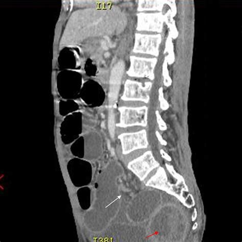 Sagittal Computed Tomography Scan Showing The Pelvic Hydatid Cyst Red Download Scientific