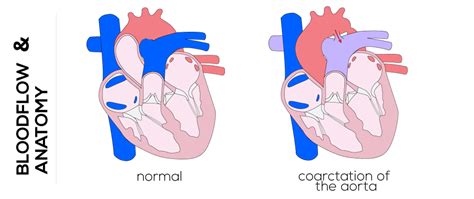 Preductal Coarctation Of Aorta