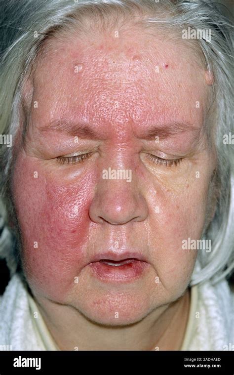 Cellulitis Red Area On The Face Of A 65 Year Old Woman Cellulitis Is
