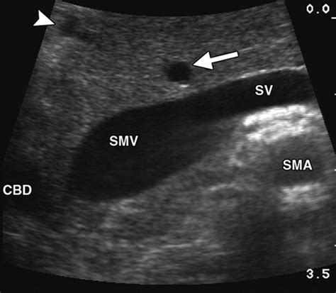 Intraoperative Ultrasonography Of The Pancreas Radiographics