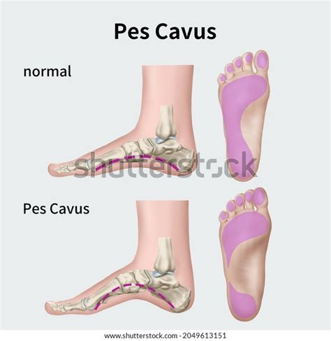 Pes Cavus 34 Bilder Stockfoton Och Vektorer Shutterstock