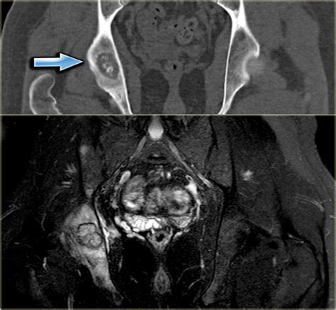 Osteoblastoma Radiology