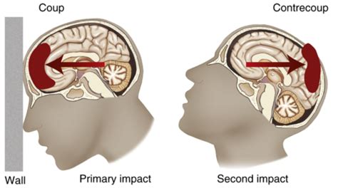 Intracranial Pressure Flashcards Quizlet