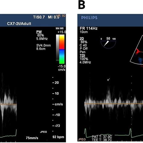 Example Measurements Of Left Atrial Appendage Wall Motion Velocity