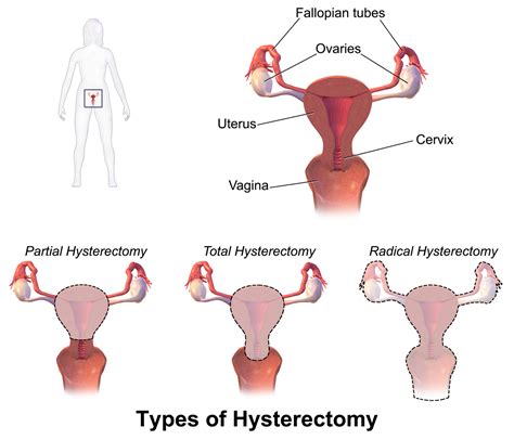 Uterus Removal Hysterectomy Surgery Cost Mumbai