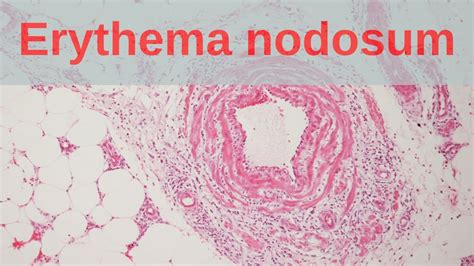 Erythema Induratum Histopathology