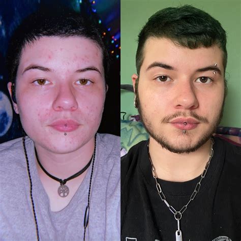 My Acne Riddled Bloated Face At 6 Months On T Vs Me Now At 2 Years On