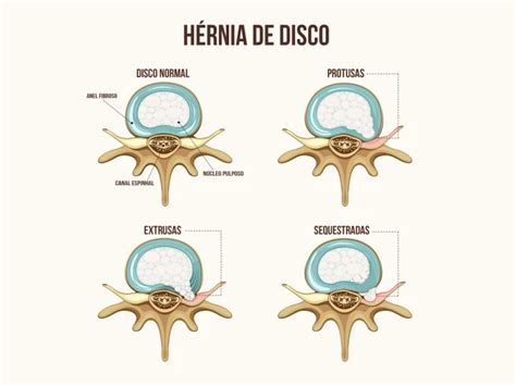 Hérnia de Disco Dr Leonardo Miguez Neurocirurgião