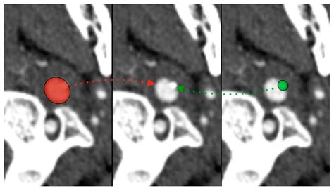 Diseases Free Full Text Stylohyoid Chain Syndrome Eagle Syndrome