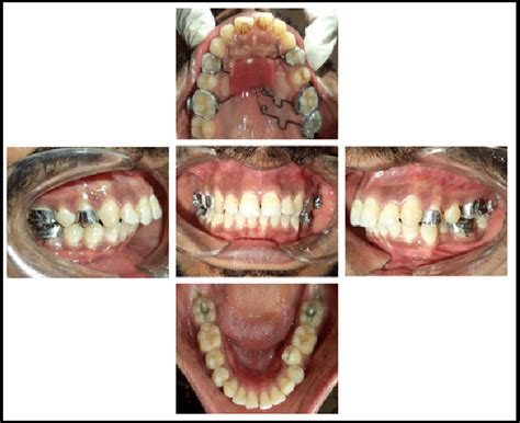 Table 1 From Class II Correction By Maxillary Molar Distalization With