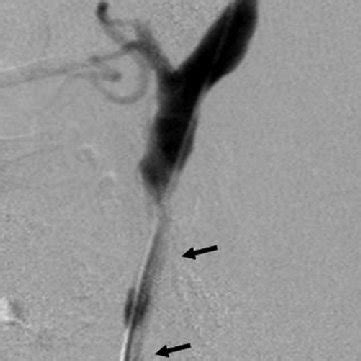 An Angiogram Following Left Common Carotid Artery Stenting And