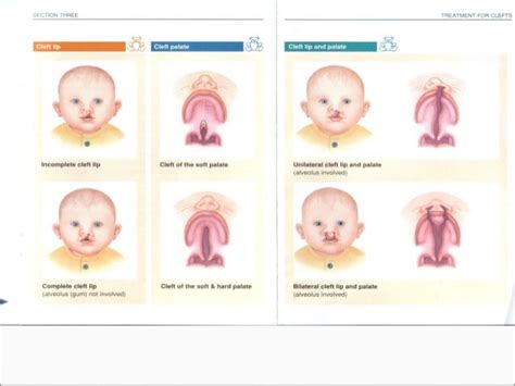 Cleft Lip And Palate Ppt