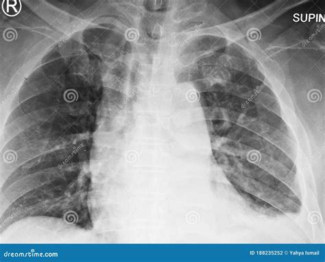 Left Lung Pleural Effusion Secondary To Trauma Haemothorax Stock Photo