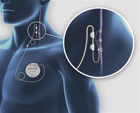 Vagal Nerve Stimulation VNS Pacific Brain Health