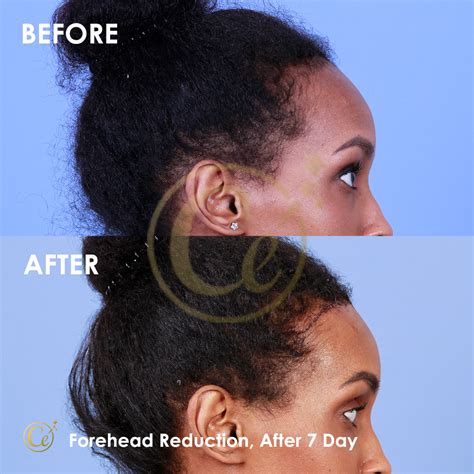 Forehead Reduction Dr Cengizhan Ekizceli