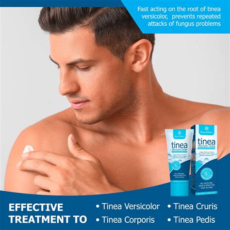 Roycederm Tinea Versicolor Treatment Athletes Foot