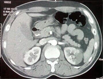 Imagenolog A Del Sistema Urinario Concise Medical Knowledge