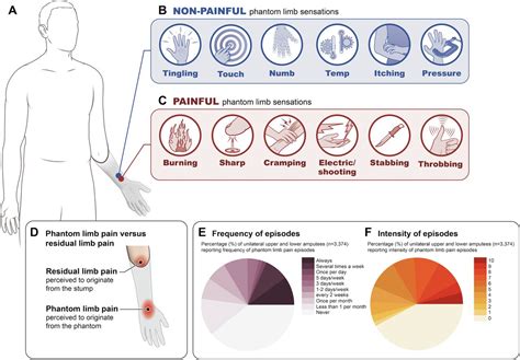 Making Sense Of Phantom Limb Pain Journal Of Neurology Neurosurgery