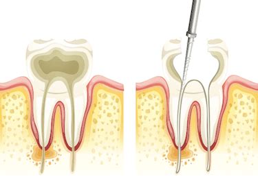 Endodoncia Multirradicular Qu Es Y Su Precio Dr Ferrer