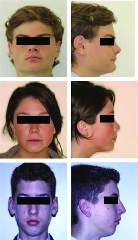 Frontal And Lateral Profile Photographs Of Orthodontic Patients With