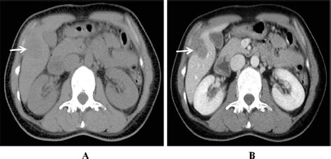 Mixed Type Non Enhanced Ct Scan Of The Abdomen Shows Coalesced