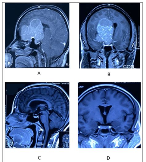 A Pre Operative Sagittal View Mri With Contrast Showing Huge Tsm Download Scientific Diagram