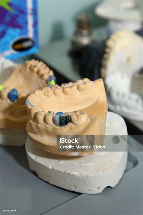 Fabrication Of Dental Crowns And Dentures Made Of Ceramic Scanning Of