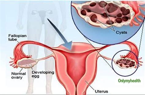 Ovarian Cyst: Know The Types, Causes, Symptoms, Treatment, Risk Factors ...