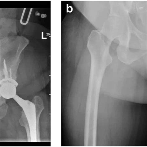 Case 4 A Preoperative Radiograph A And A Postoperative Radiograph