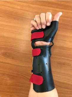 A new splint design for De Quervains Tenosynovitis - GC Hand Therapy